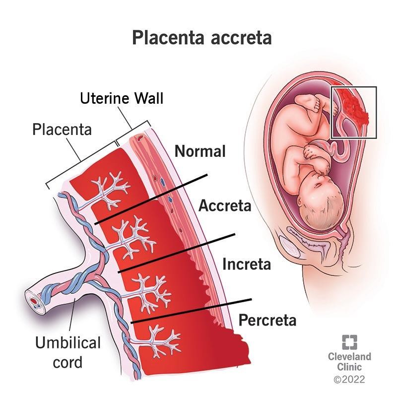 placenta percreta treatment pune